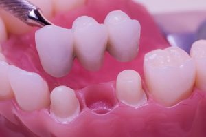 Dental Bridges in Surfside and Miami, FL Banner